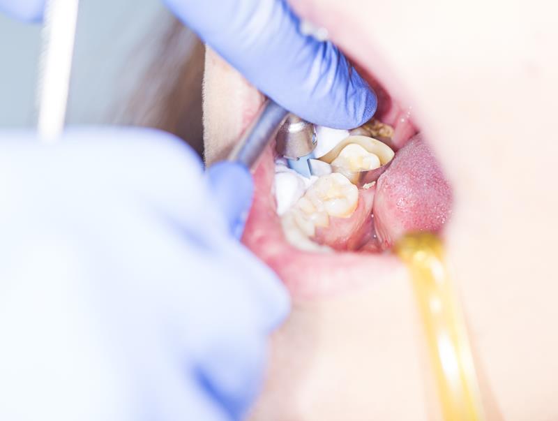 Cosmetic Bonding in Safety Harbor