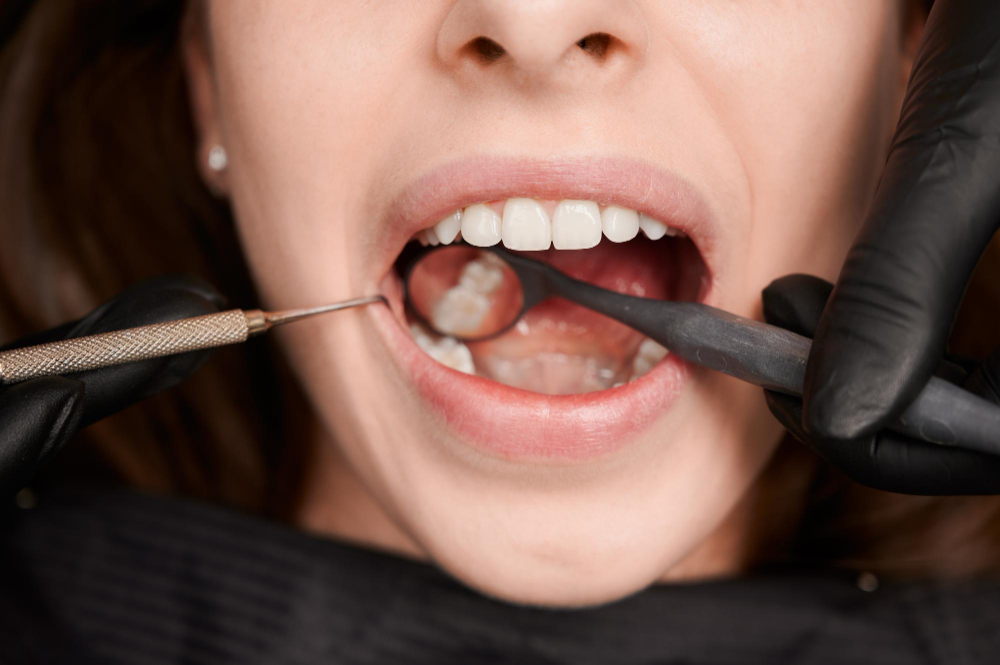 Composite Fillings in Safety Harbor